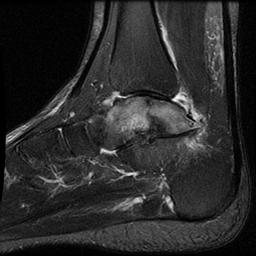 Talus Body Nonunion MRI